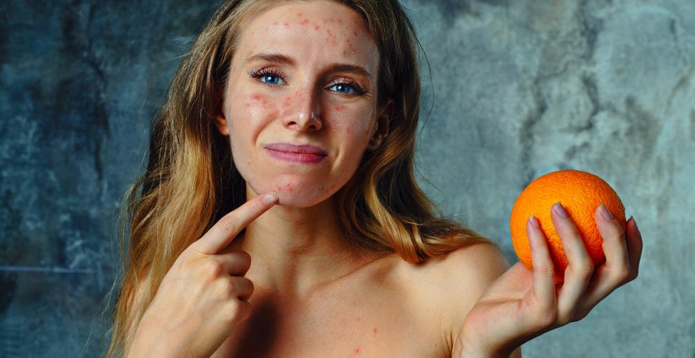 Le régime végétarien contre l'acné ?